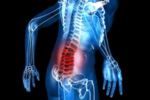 Back Pain X-Ray Image